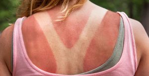 quemadura solar y su cuidado