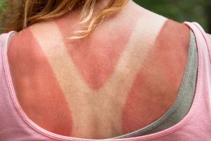 quemadura solar y su cuidado